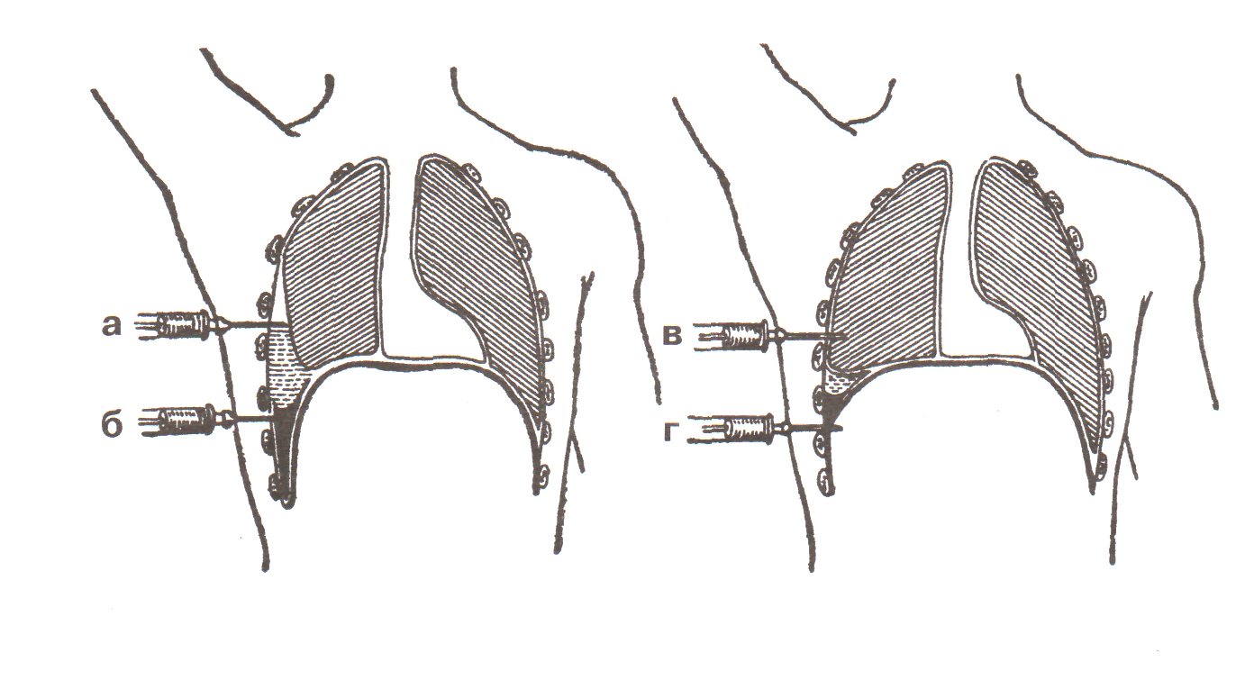 Плевральная пункция рисунок