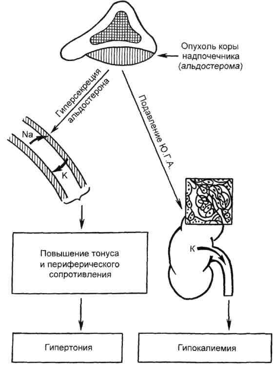 Синдром конна презентация патофизиология