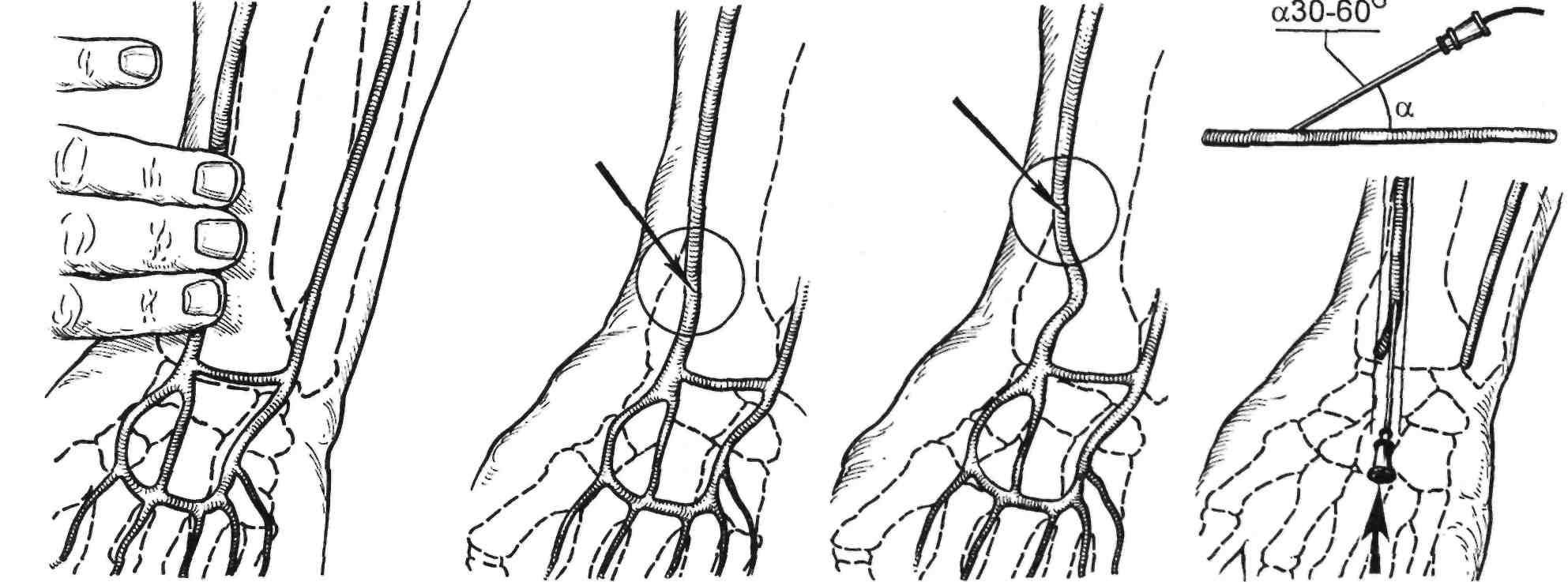 Рука после стентирования. Пункция лучевой артерии. Пункция правой лучевой артерии по Сельдингеру. Пункция и катетеризация лучевой артерии. Катетеризация лучевой артерии.