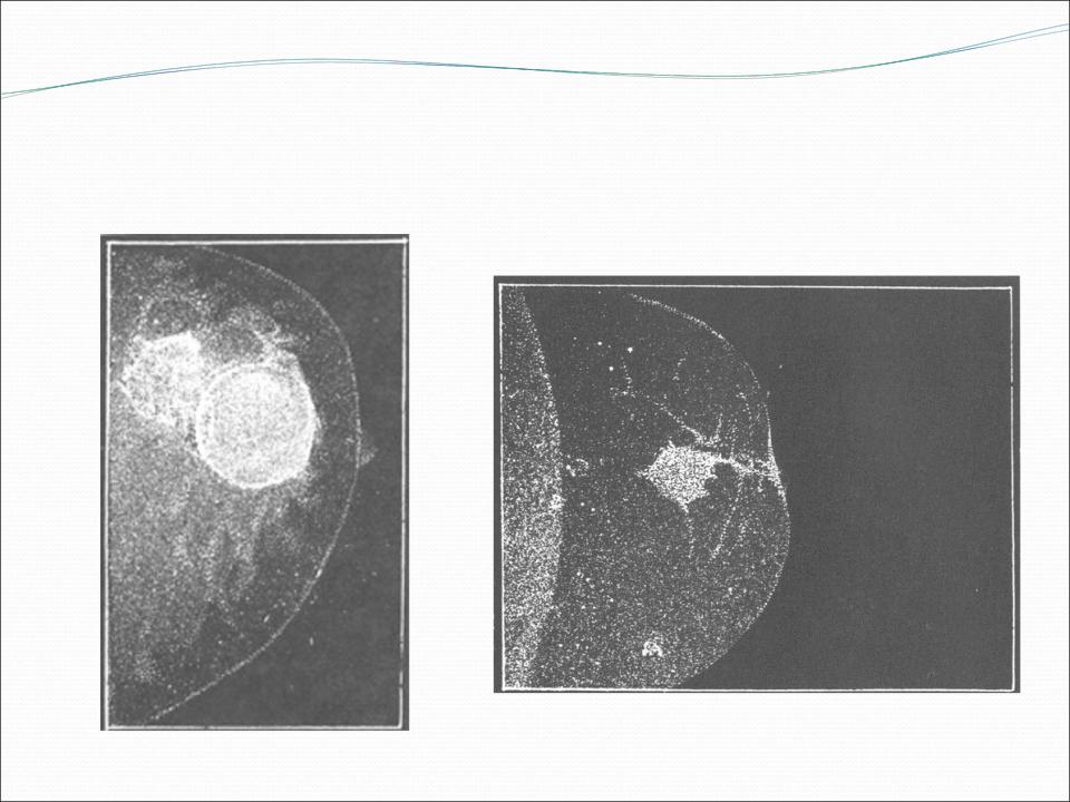 Маммография уплотнения. Галактоцеле на маммографии. Галактоцеле молочной железы на рентгене. Галактоцеле молочной железы маммография. Галактоцеле молочной железы цитология.