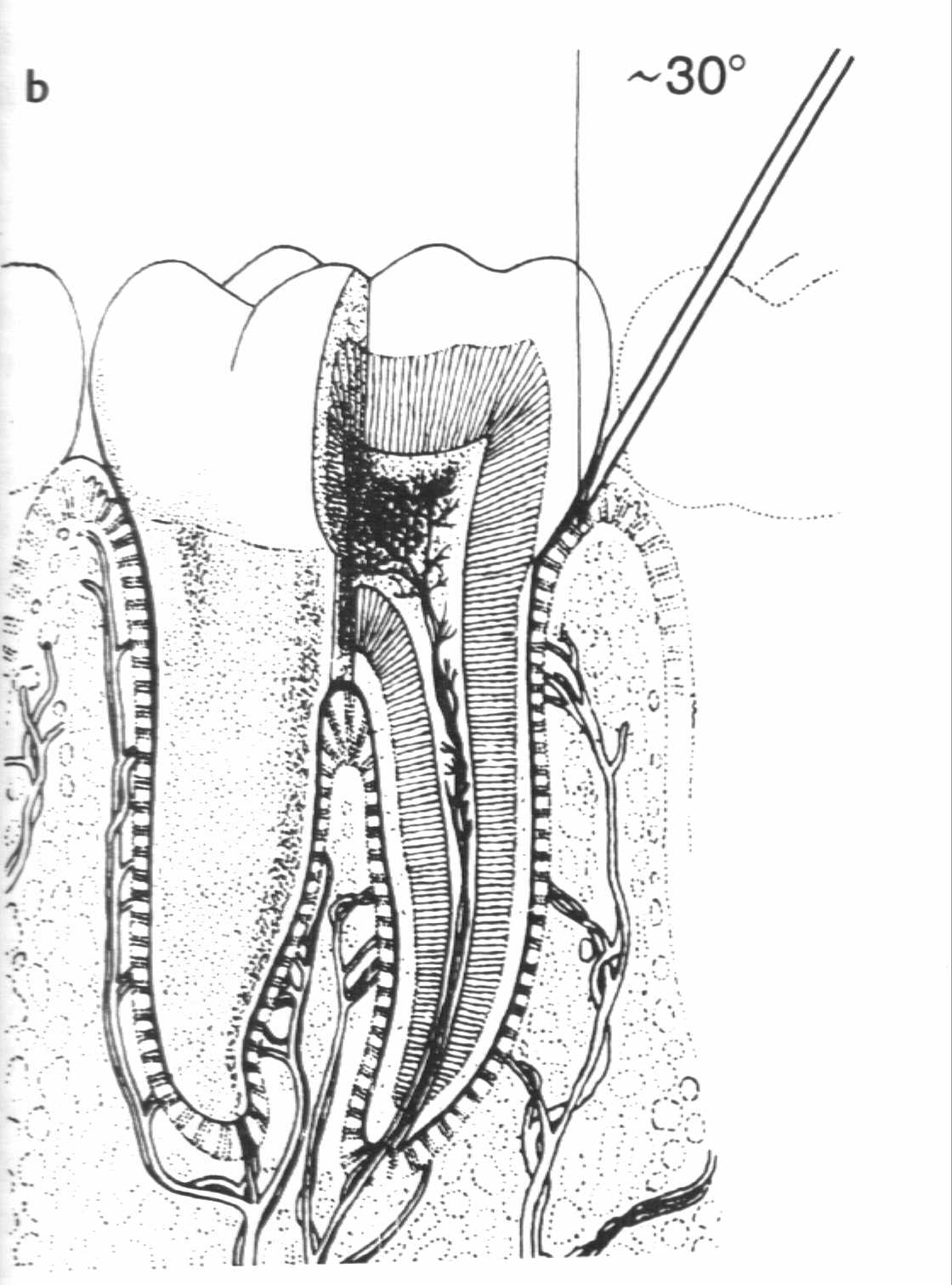 Переходная складка слизистой. Периодонтальный абсцесс. Интралигаментарная анестезия. Поднакостничнаяанестезия в стоматологии. Периодонтальный абсцесс десны.