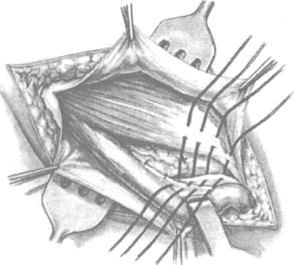 Операция кукуджанова при паховой грыже