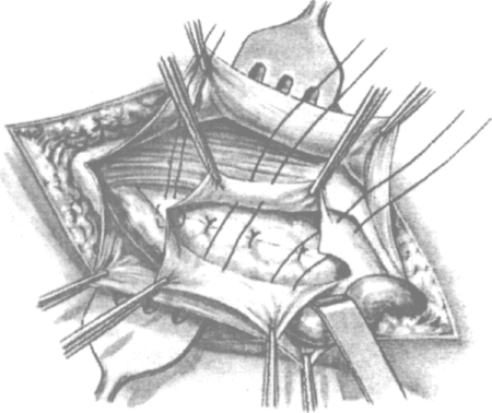 Операция кукуджанова при паховой грыже