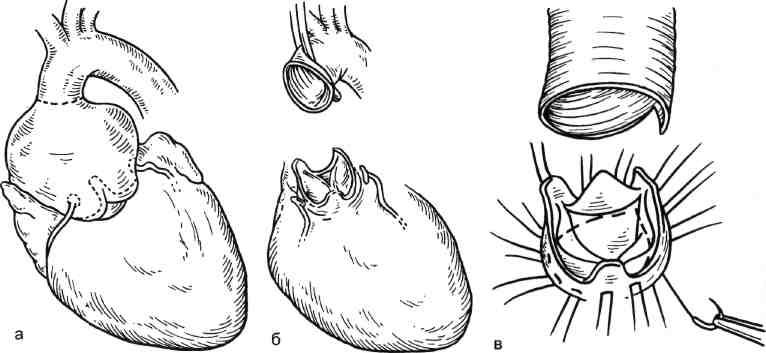 Операция клапана. Протезирование аортального клапана схема. Реимплантация аортального клапана. Протезирование аортального клапана ход операции. Замена аортального клапана операция.