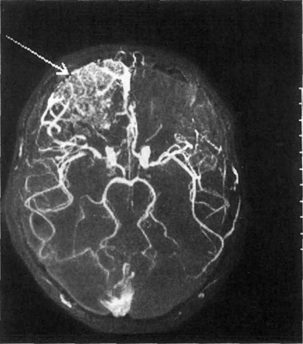 Ангиография головного мозга. Артериовенозная мальформация ангиография. Кт ангиография сосудов головного мозга. Артериовенозная мальформация кт-ангиографии. Артериовенозная мальформация сосудов головного мозга на кт.