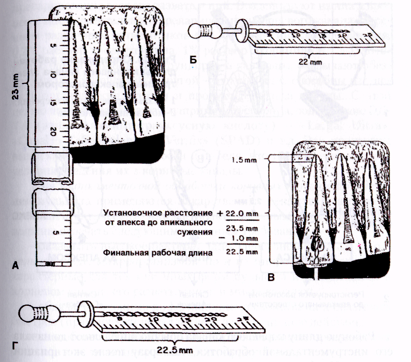 Определение корневых каналов. Методы определения рабочей длины корневого канала зубов. Определение рабочей длины зуба рентгенологическом методом.. Методы измерения рабочей длины корневого канала. Способы определения рабочей длины корневого канала.