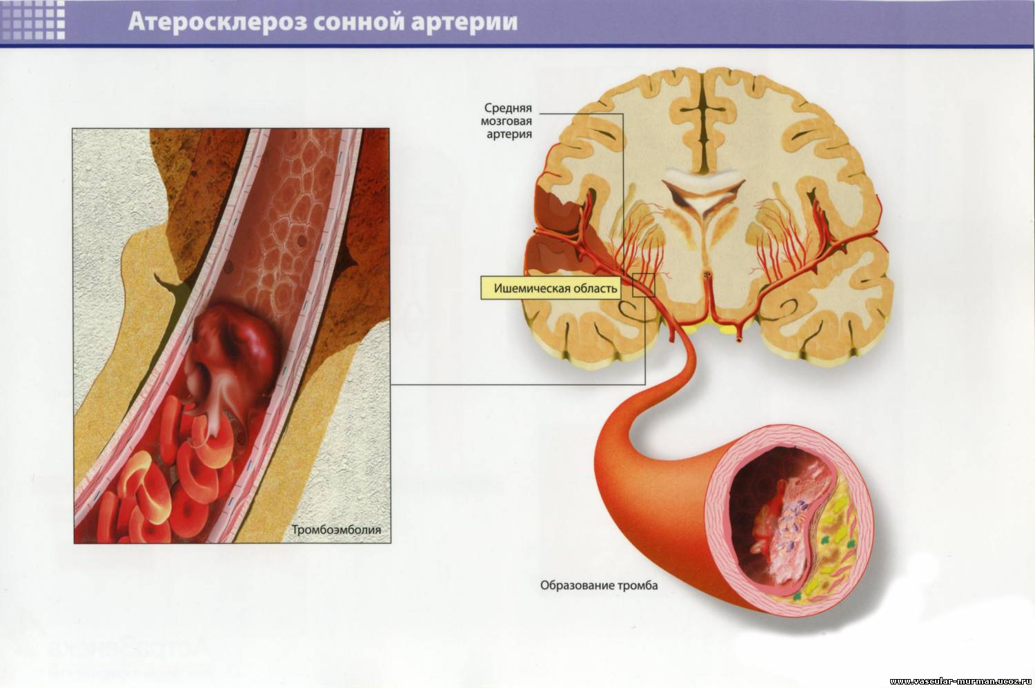 Тромбозы сосудов головного