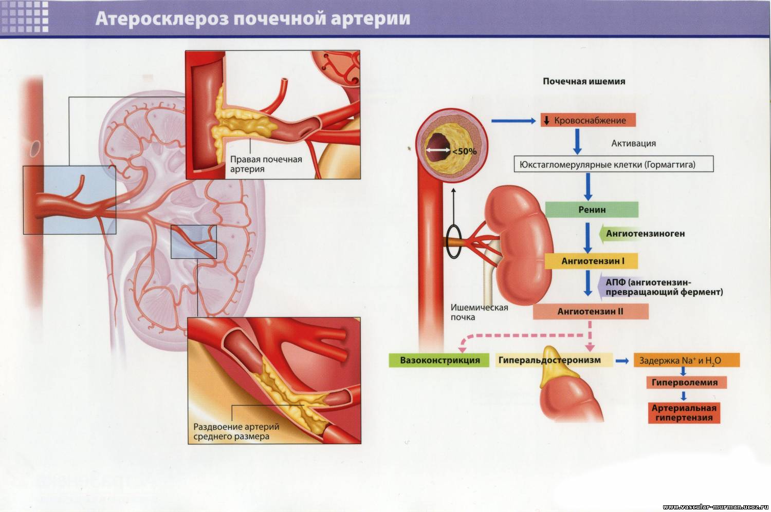 Тромбоз почечных вен. Атеросклероз артерий почек почечная форма. Осложнения атеросклероза артерий почек. Атеросклероз почечных сосудов характеризуется:. Гипертоническая болезнь сосуды почек.