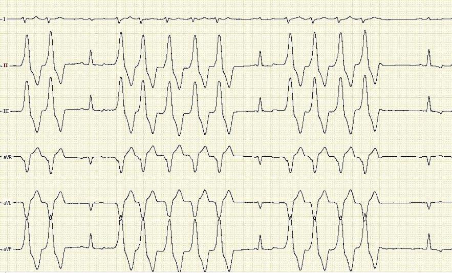 Желудочковая экстрасистолия картинки