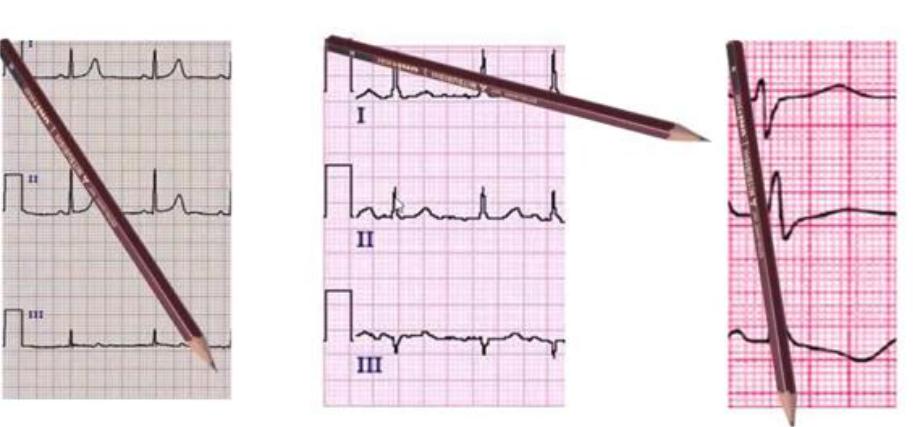 Ось экг. ЭКГ 1228.9. Угол Альфа 30 градусов на ЭКГ. Метод карандаша в ЭКГ. ЭКГ электроось.