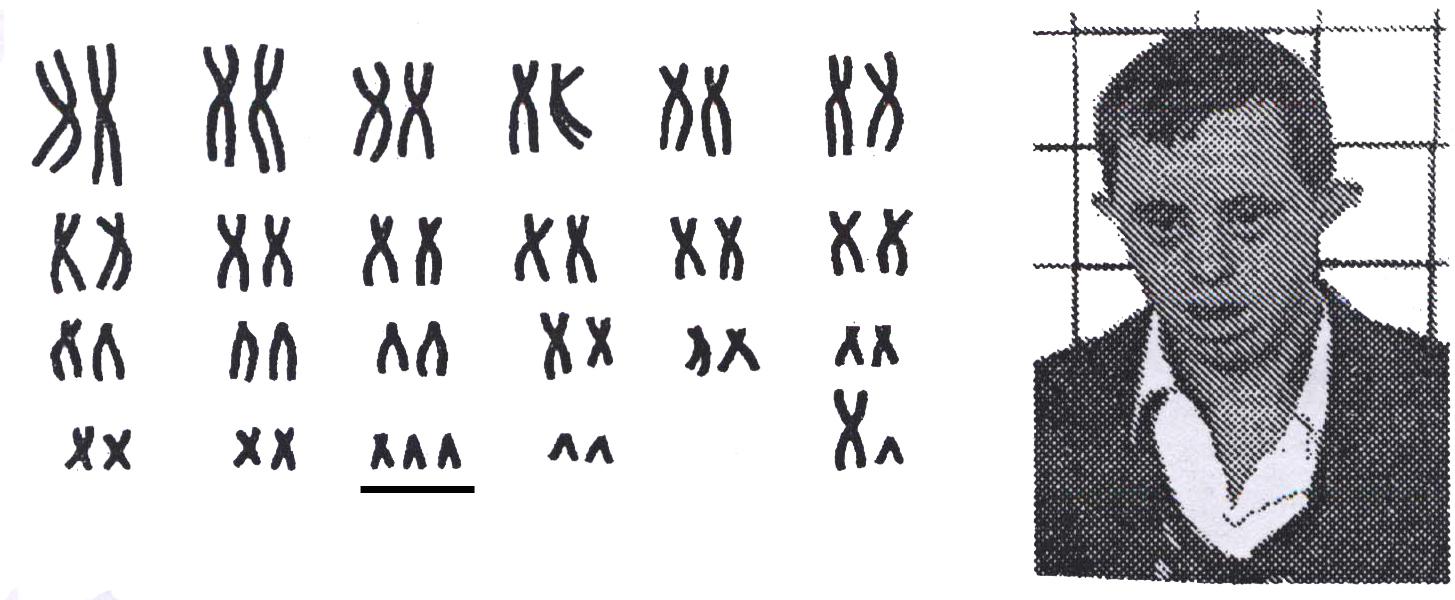 Сколько хромосом у людей с синдромом дауна