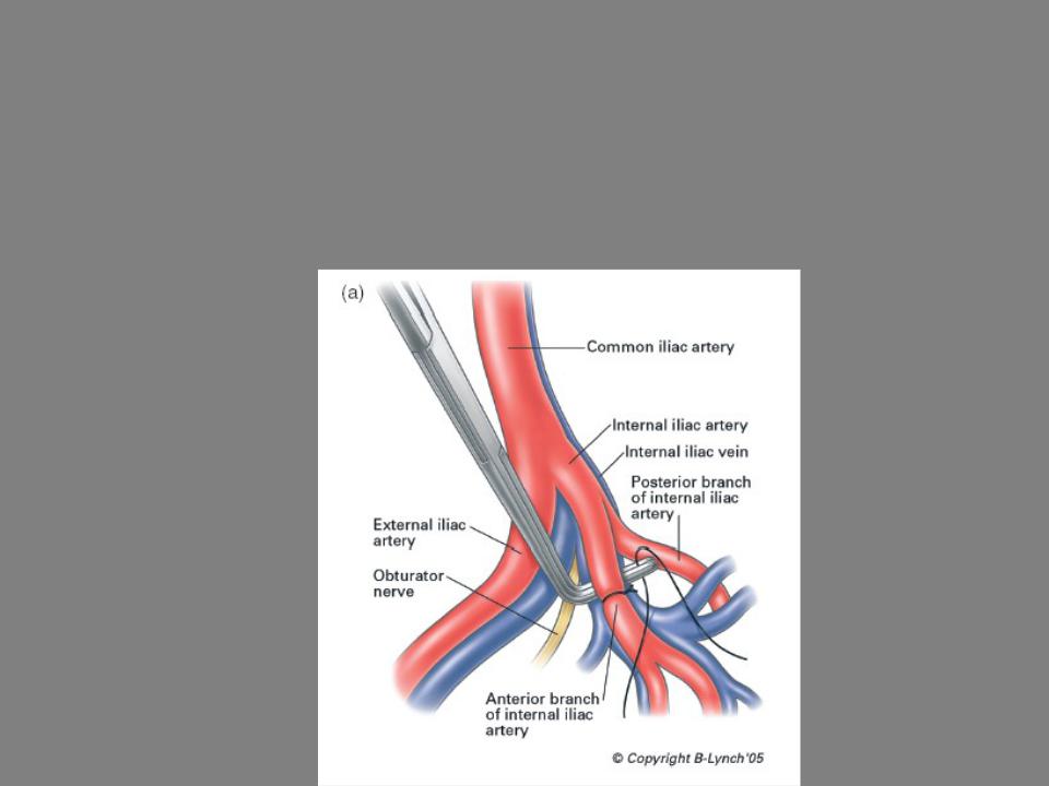 Правая подвздошная артерия. Общая, наружная и внутренняя подвздошные артерии и вены. Аневризмы левой общей подвздошной артерии. Операция перевязка внутренних подвздошных артерий. Перевязка внутренней подвздошной артерии техника.