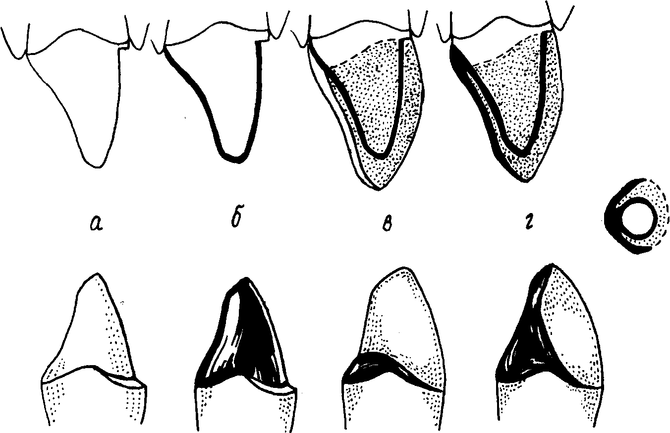 Препарирование зуба под комбинированные коронки по Белкину
