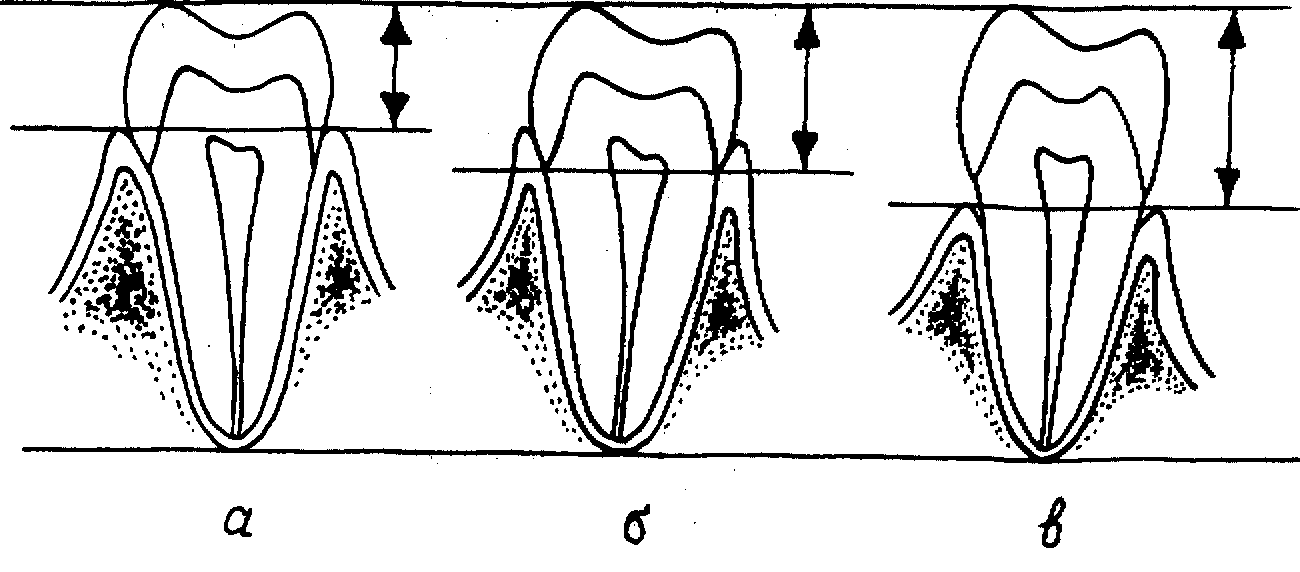 Какую функцию выполняет шейка зуба. Клиническая и анатомическая шейка зуба. Анатомическая и клиническая коронка зуба. Понятия анатомическая шейка зуба. Строение зуба клиническая шейка.