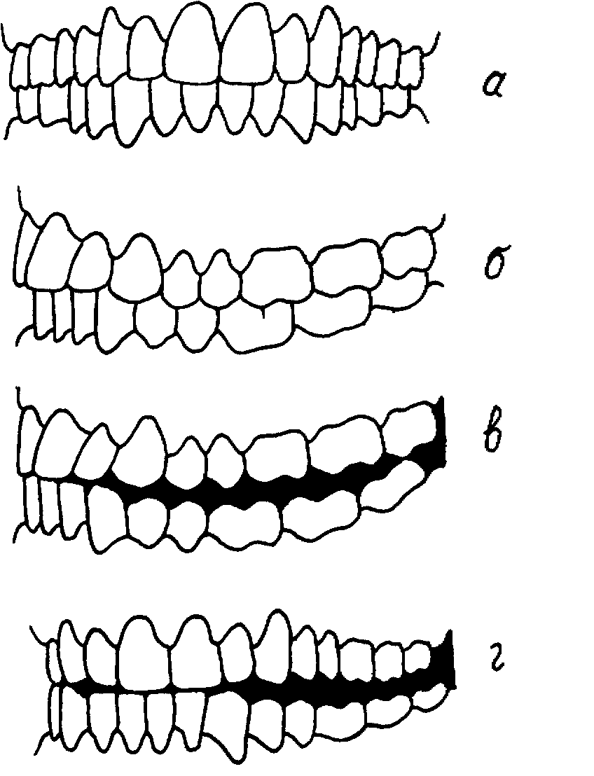 Вид смыкания зубных рядов