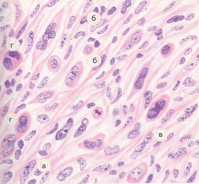 Фибросаркома микропрепарат рисунок