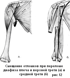 Переломы диафиза плечевой кости классификация