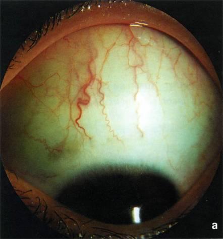 К изменениям глаза при врожденной глаукоме относится