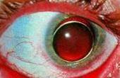 Острая глаукома диф диагноз