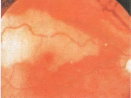 Острые нарушения артериального кровообращения в сетчатке характеризуются