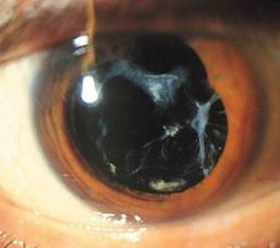 Дифференциальная диагностика острой глаукомы