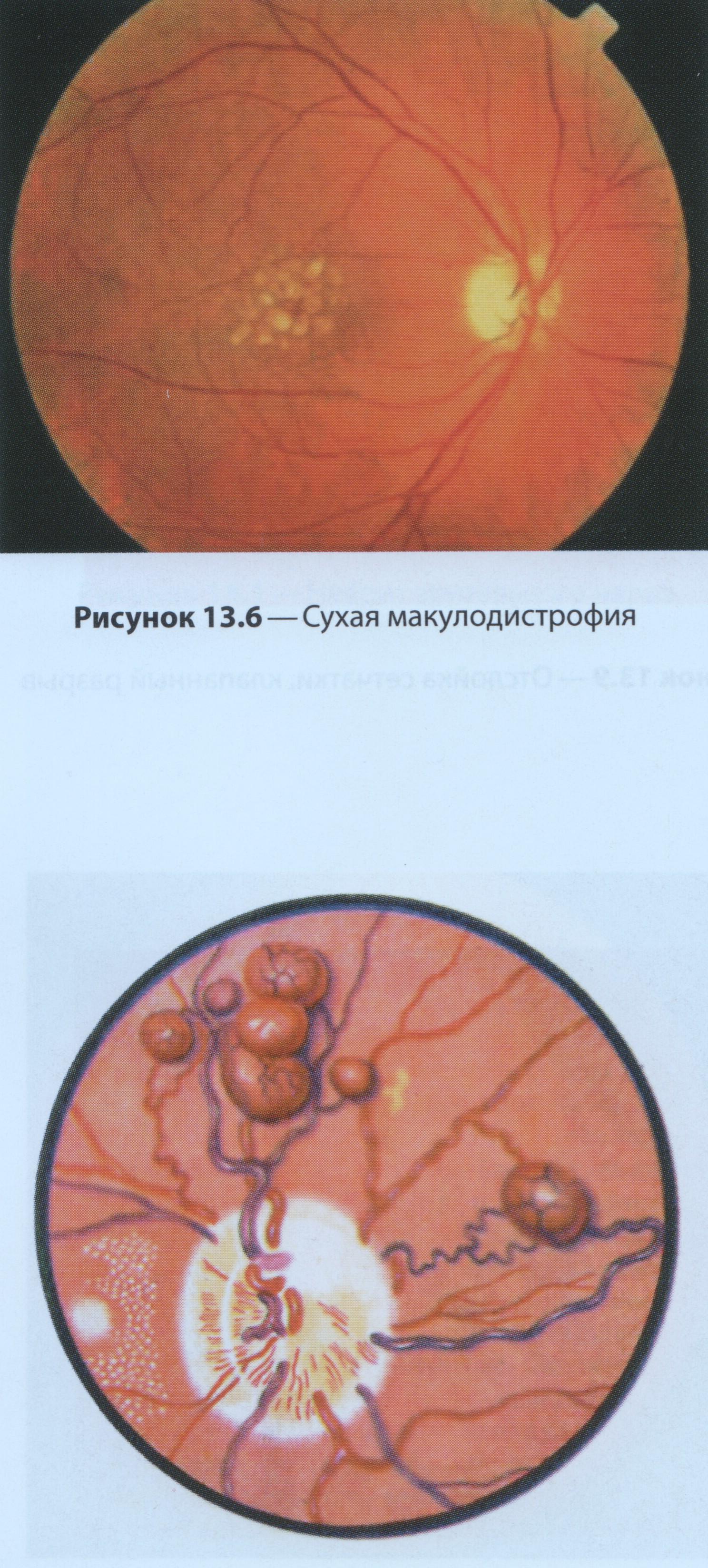 Факоматоз с поражением сетчатки