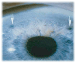 Миотические средства и средства для лечения глаукомы