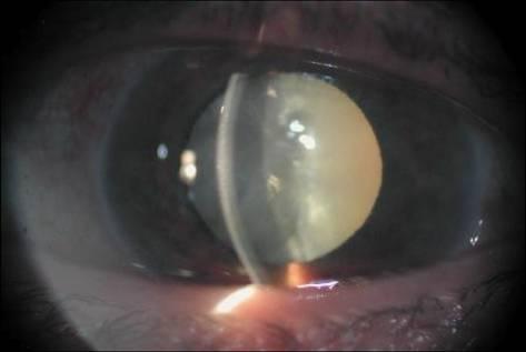 Острая глаукома диф диагноз