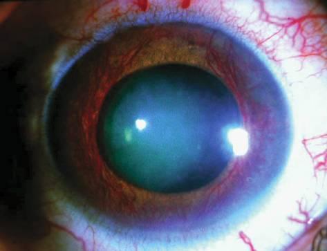 Дифференциальная диагностика острой глаукомы