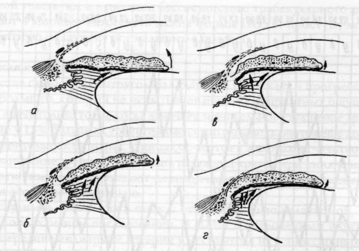 Роговица при врожденной глаукоме