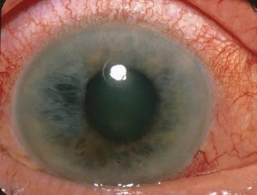 К изменениям глаза при врожденной глаукоме относится