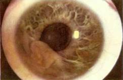 Дифференциальная диагностика острой глаукомы thumbnail