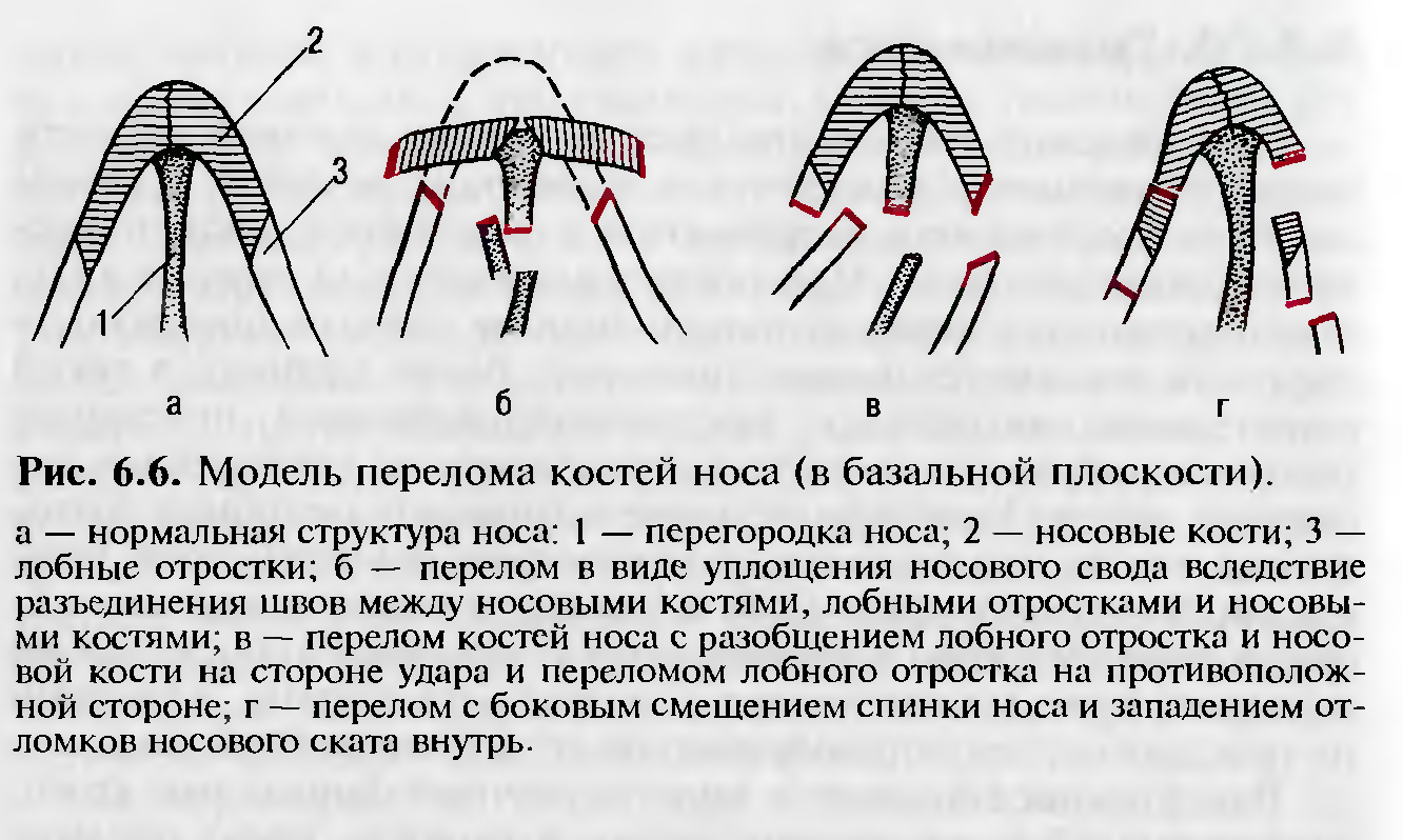 Перелом костей носа Перелом костей носа
