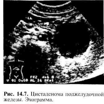 Муцинозная цистаденома поджелудочной железы. Цистаденокарцинома поджелудочной. Цистаденома поджелудочной железы кт. Серозная цистаденома поджелудочной железы. Муцинозная цистаденокарцинома поджелудочной железы.