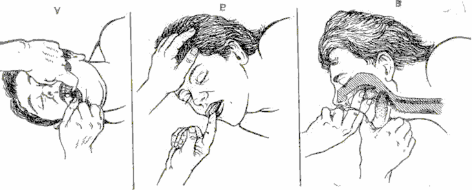 Очистка дыхательных путей. Пальцевое исследование носоглотки. Методы удаления инородных тел из гортани. Инородные тела верхних дыхательных путей. Помощь при инородном теле в глотке