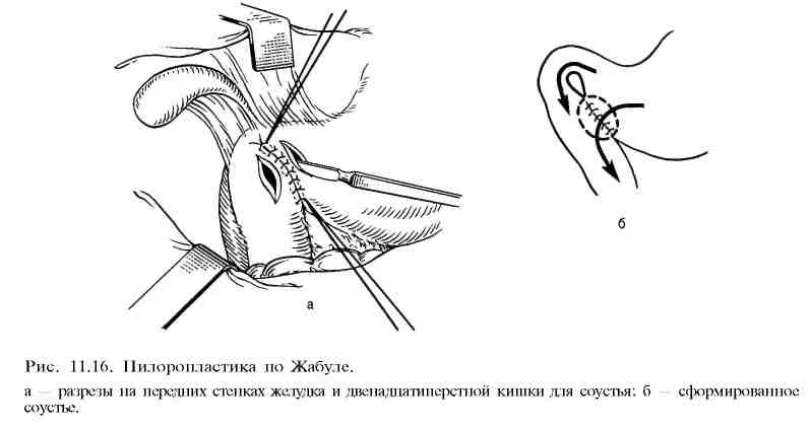 Пилоропластика по финнею схема