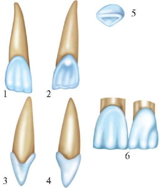 Клыки поверхность зуба. Латеральный резец верхней челюсти анатомия. Боковой резец верхней челюсти анатомия. Центральный резец верхней челюсти анатомия. Латеральный резец нижней челюсти анатомия.