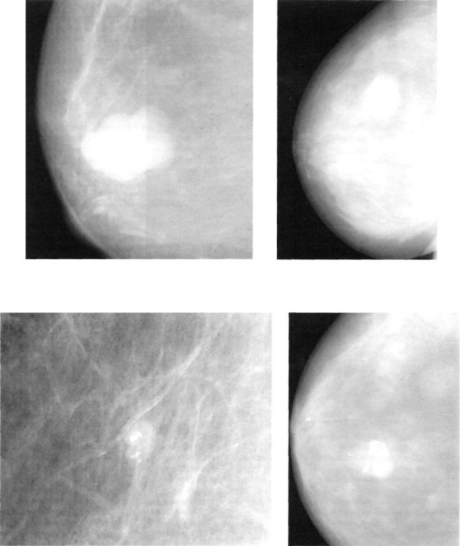 Фото маммографии с фиброаденомой