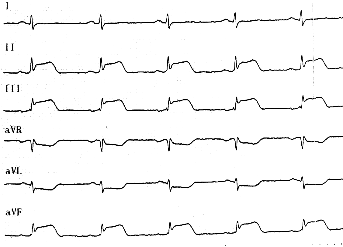 Экг подъем. Острый трансмуральный инфаркт миокарда ЭКГ. Трансмуральный инфаркт миокарда на ЭКГ. Острый трансмуральный инфаркт нижней стенки миокарда ЭКГ. ЭКГ ОИМ С подъемом сегмента St.
