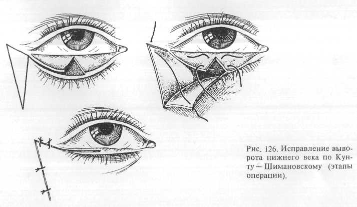 Ход века. Конъюнктивальный лоскут. Горизонтальное укорочение Нижнего века. Массаж век при блефарите схема. Пластика выворота Нижнего века схема.