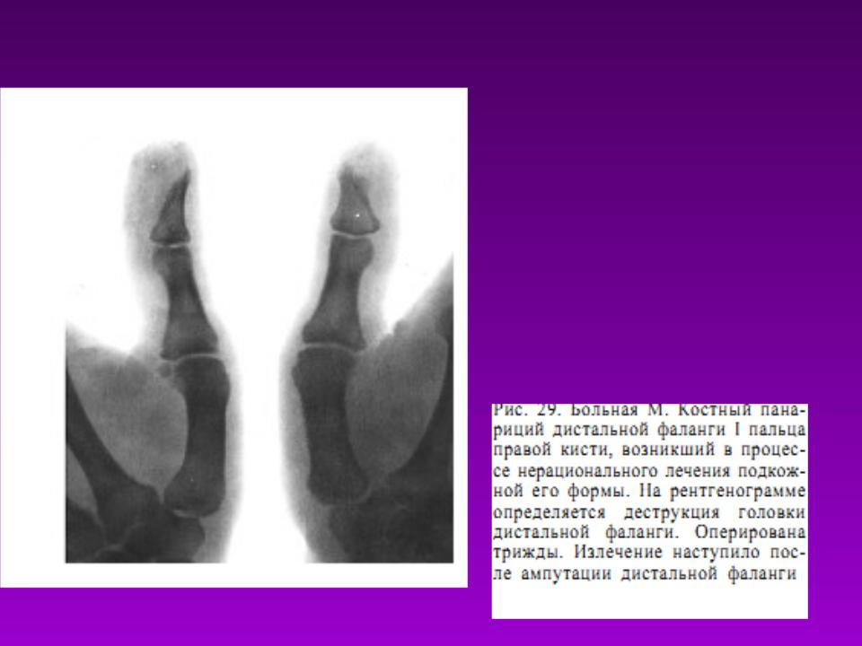 Ампутация кисти мкб 10. Эпифизеолиз дистальной фаланги 3 пальца. Эпифизеолиз основной фаланги 1 пальца. Эпифизеолиз рентген кисть. Эпифизеолиз концевой фаланги кисти.