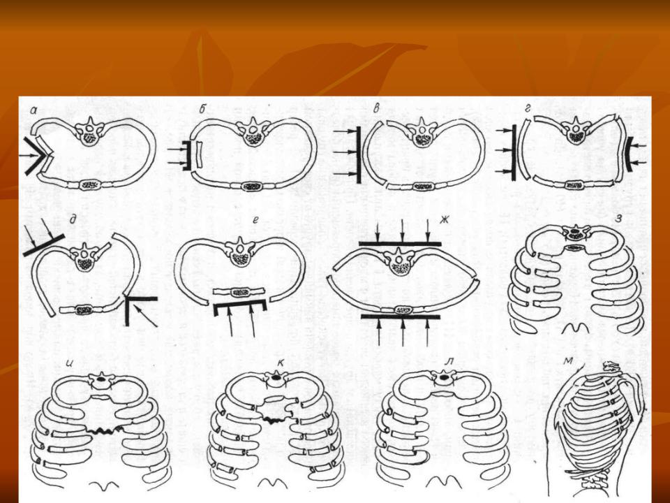 Прямые ребра. Разгибательный перелом ребер. Непрямые переломы ребер механизм образования. Переломы ребер судебная медицина механизм. Прямой и непрямой перелом ребер.