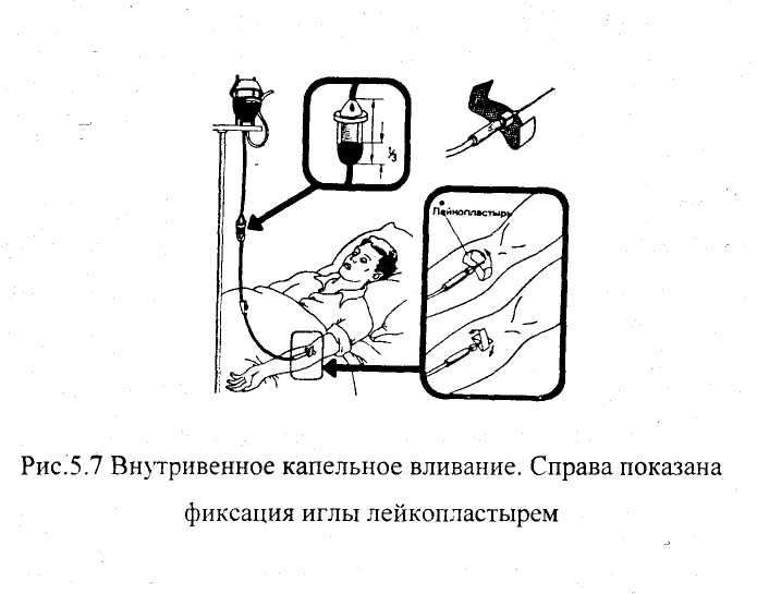 Внутримышечные инъекции