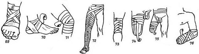 Перевязка большого пальца ноги бинтом схема - 91 фото