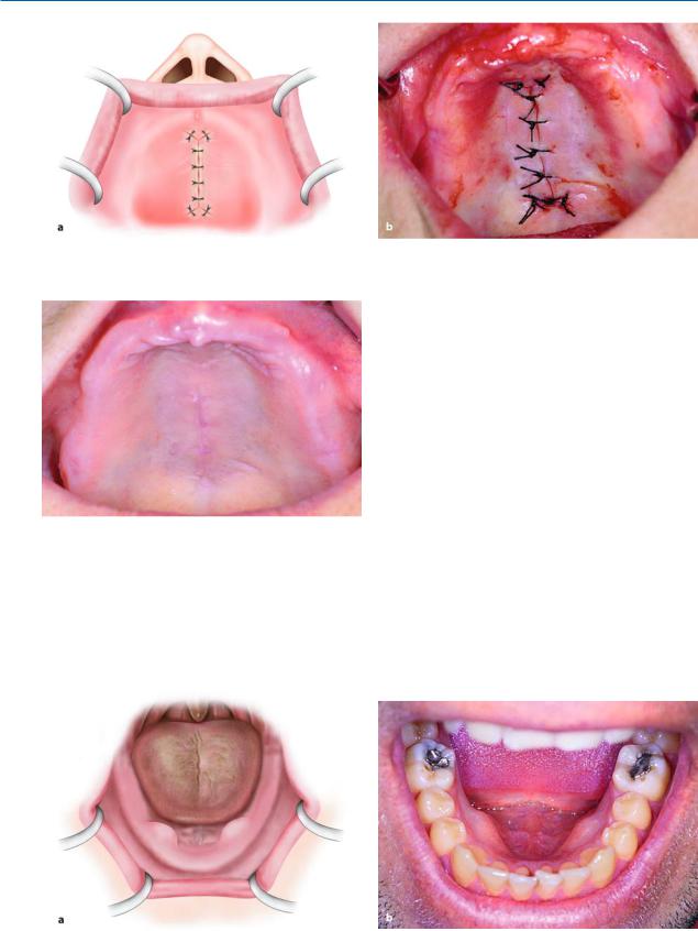 10. Preprosthetic Surgery