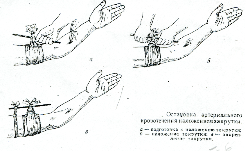 Наложение жгута на бедро