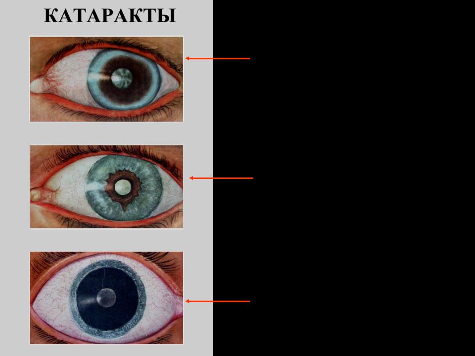 Презентация на тему катаракта