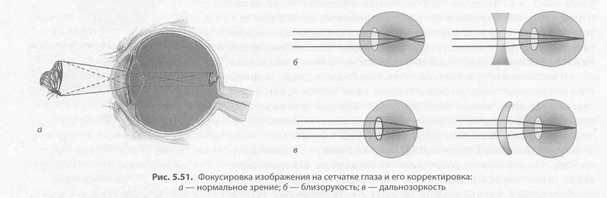 Нормальный глаз схема. Фокусировка изображения на сетчатке. Изображение фокусируется на сетчатке. Фокусировка света на сетчатке. Строение глаза при близорукости и дальнозоркости.