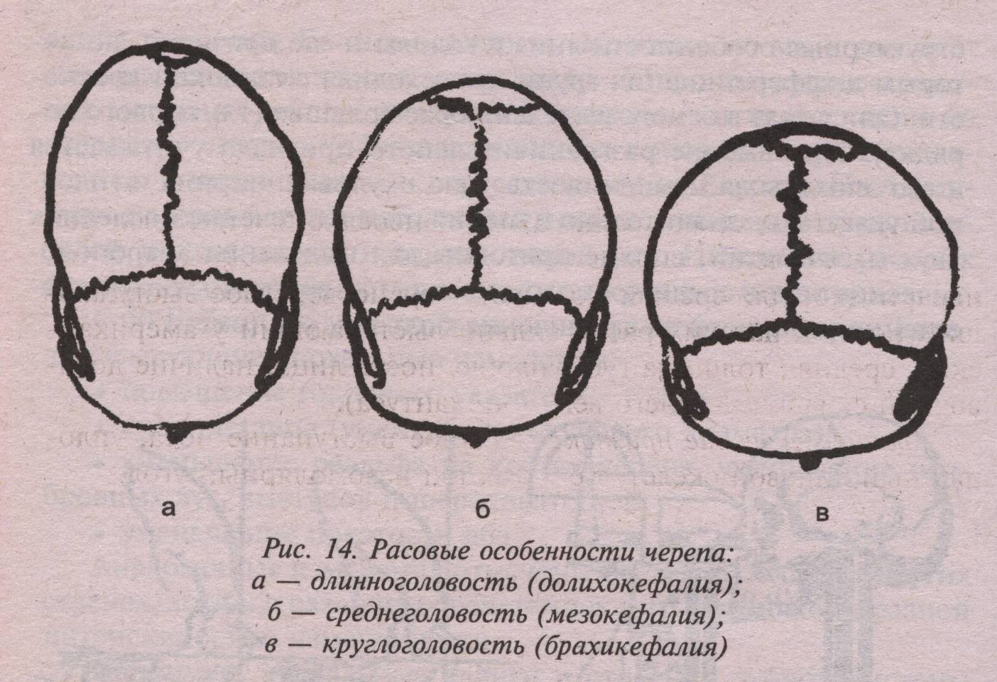 Варианты формы черепа. Брахикефалия это в антропологии. Деформация черепа долихоцефалия. Брахикефалия мезокефалия долихокефалия.