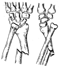 Перелом костей предплечья классификация